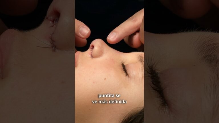 Sofi tiene una nariz que no le gusta y este es el resultado inmediato de su #rinoplastia